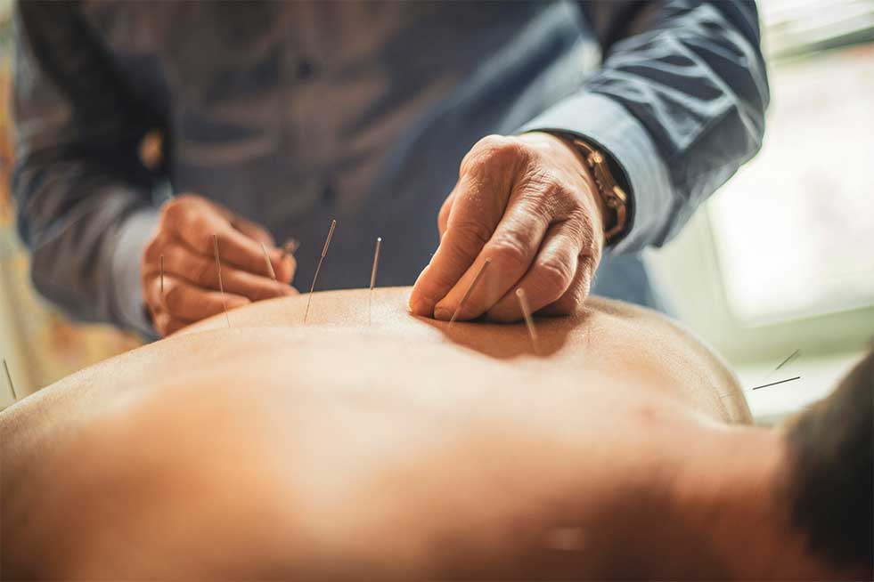 Acupuncture